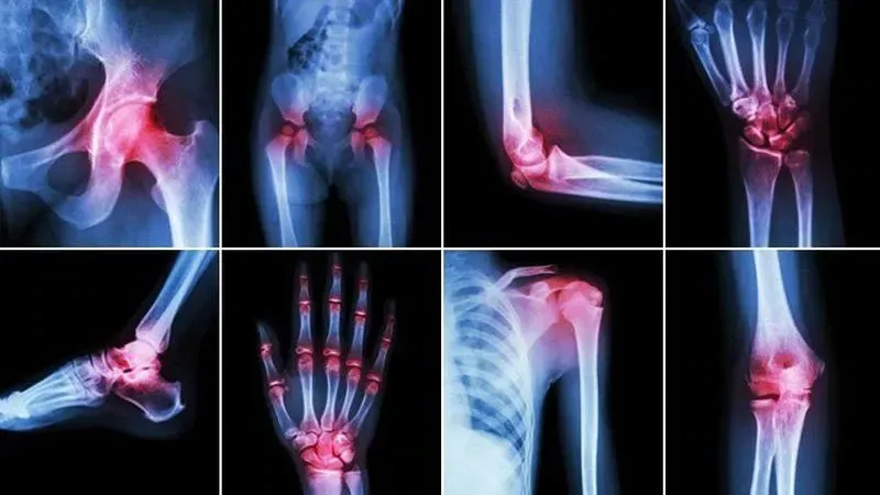 Arthrose